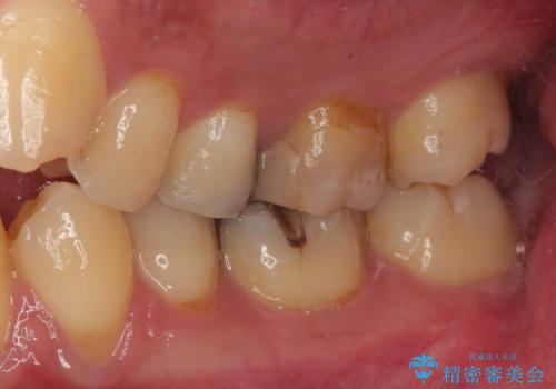 奥歯がたまにしみる MTAによる生活歯髄療法・オールセラミッククラウンの治療前