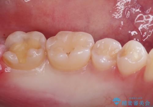 【セラミックインレー】黒いのが気になるの治療中