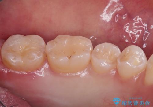 【セラミックインレー】黒いのが気になるの治療後