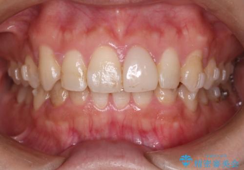 【インビザラインとセラミック】前歯を綺麗にの治療中