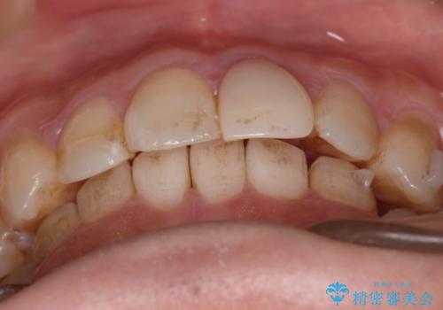 【インビザラインとセラミック】前歯を綺麗にの治療中