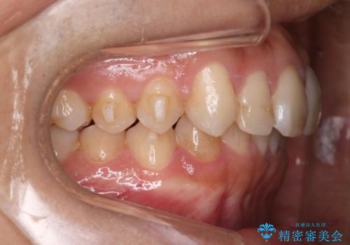 【インビザラインとセラミック】前歯を綺麗にの治療中