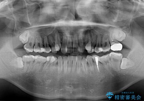 前歯のデコボコを抜歯矯正で改善した症例|目立ちにくい審美装置を使用の治療前