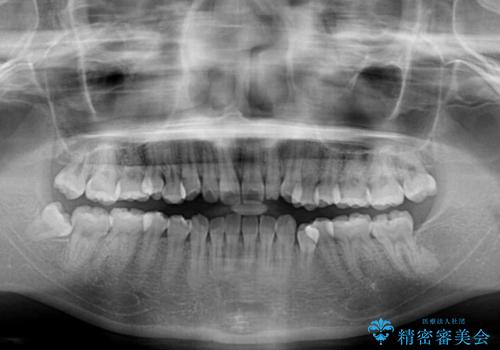 早く・確実に歯並び改善|目立ちにくいワイヤー矯正の治療前