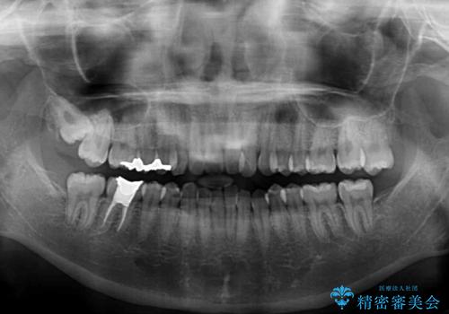 【モニター】デコボコとクロスバイトの前歯　ワイヤー装置での抜歯矯正の治療前