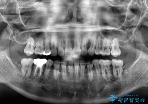 【モニター】デコボコとクロスバイトの前歯　ワイヤー装置での抜歯矯正の治療後