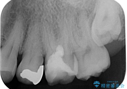 奥歯がたまにしみる MTAによる生活歯髄療法・オールセラミッククラウンの治療中