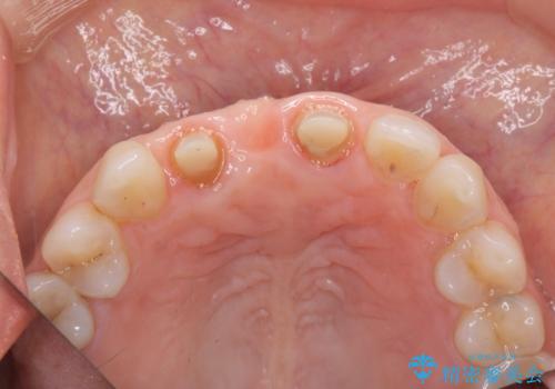 外れやすい前歯のブリッジ しっかりとした治療を受けたいの治療中