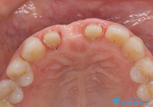 外れやすい前歯のブリッジ　しっかりとした治療を受けたいの治療後