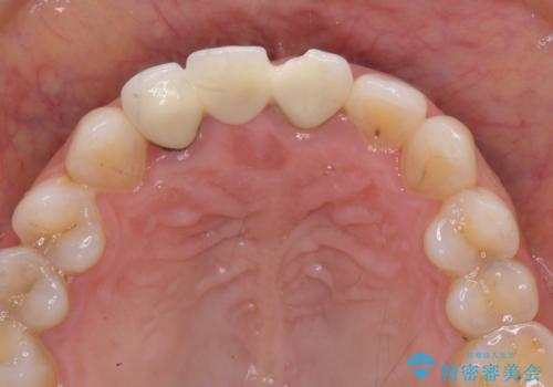 外れやすい前歯のブリッジ　しっかりとした治療を受けたいの治療前
