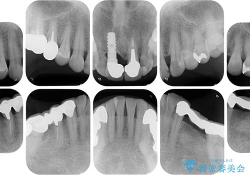 【海外から通院】統一感のない前歯をきれいに　オールセラミッククラウン治療の治療前