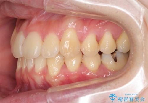 ねじれ・がたつきのある前歯を改善の治療後