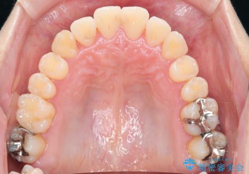 ねじれ・がたつきのある前歯を改善の治療後