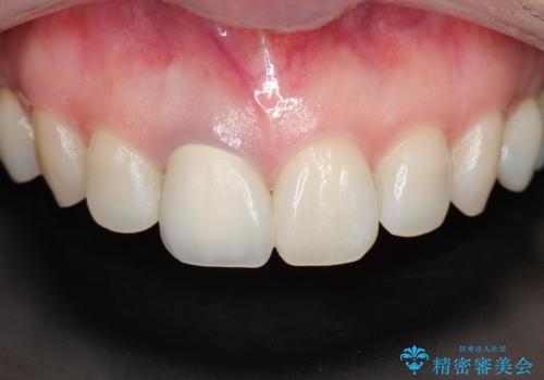 前歯の色が気になる。