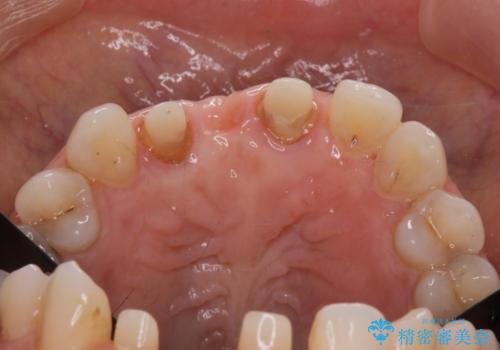 外れやすい前歯のブリッジ しっかりとした治療を受けたいの治療中