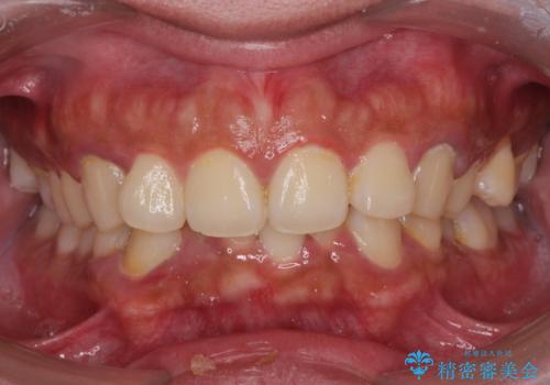 がたつきが気になる。インビザラインでスッキリ。