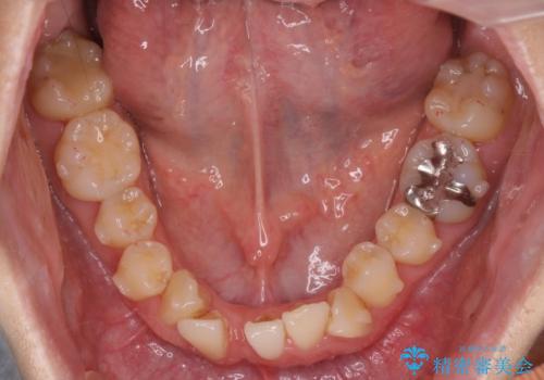 ねじれ・がたつきのある前歯を改善の治療前