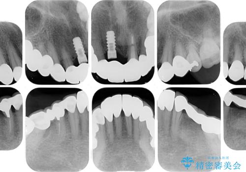【海外から通院】統一感のない前歯をきれいに オールセラミッククラウン治療の治療後