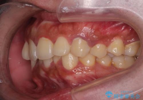 がたつきが気になる。インビザラインでスッキリ。の治療前