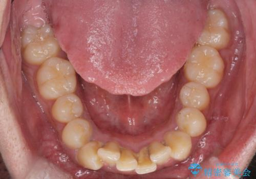 がたつきが気になる。インビザラインでスッキリ。の治療前