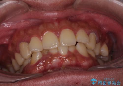 がたつきが気になる。インビザラインでスッキリ。の治療中