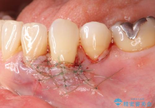 [ 根面被覆 ]  歯ぐきのさがりを移植で改善の治療中