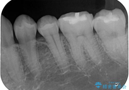 【セラミックインレー】黒いのが気になるの治療前