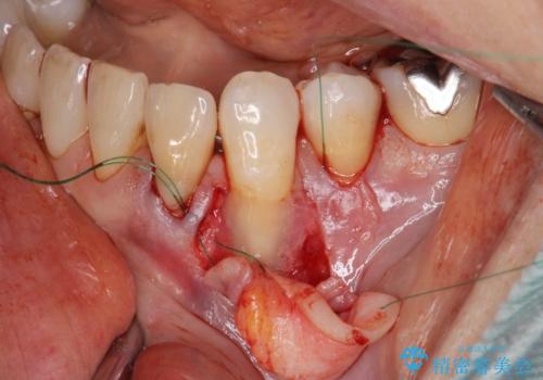 [ 根面被覆 ]  歯ぐきのさがりを移植で改善の治療前