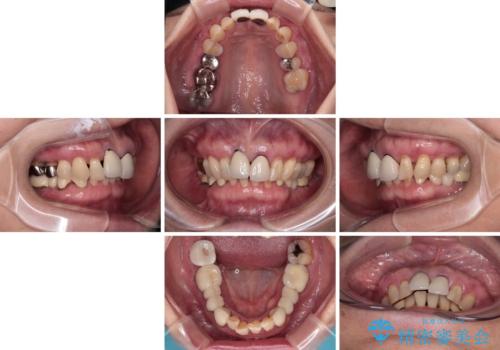 【海外から通院】統一感のない前歯をきれいに オールセラミッククラウン治療の治療前