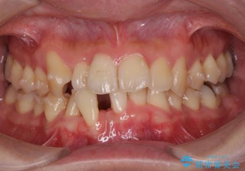 ねじれ・がたつきのある前歯を改善の治療前