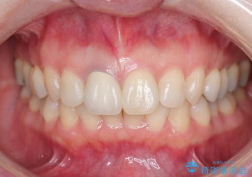 前歯の色が気になる。の治療前