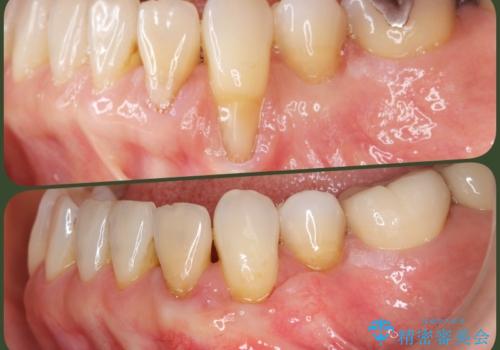 [ 根面被覆 ]  歯ぐきのさがりを移植で改善