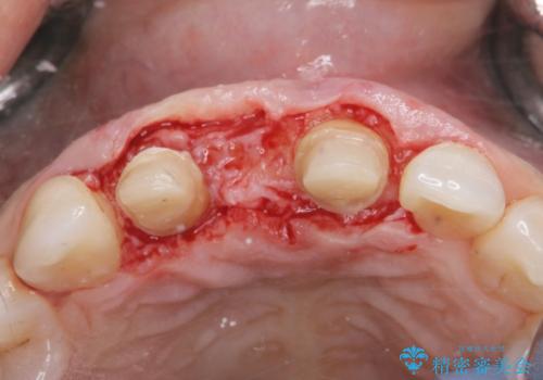 外れやすい前歯のブリッジ しっかりとした治療を受けたいの治療後
