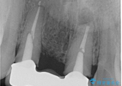 外れやすい前歯のブリッジ しっかりとした治療を受けたいの治療前