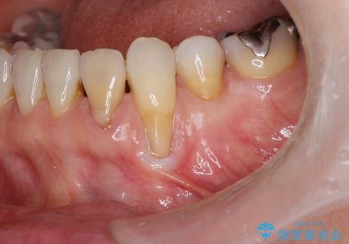 [ 根面被覆 ]  歯ぐきのさがりを移植で改善の治療前