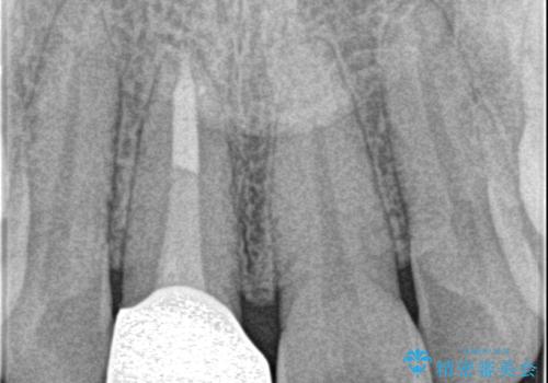 前歯の色が気になる。の治療後