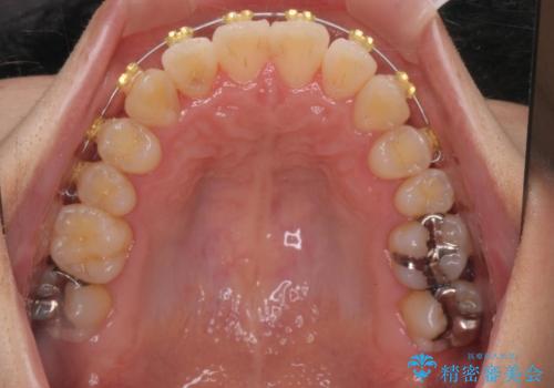 ねじれ・がたつきのある前歯を改善の治療中