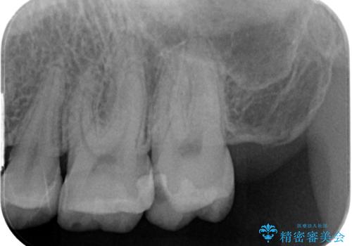 詰め物が欠けたのでやり替えたい　セラミックインレー修復の治療前