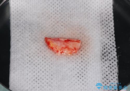 [ 根面被覆 ]  歯ぐきのさがりを移植で改善の治療中