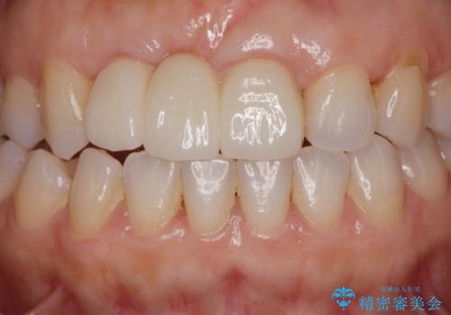 外れやすい前歯のブリッジ しっかりとした治療を受けたいの治療後