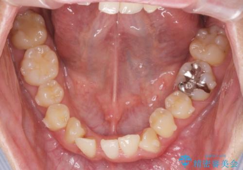 ねじれ・がたつきのある前歯を改善の治療中