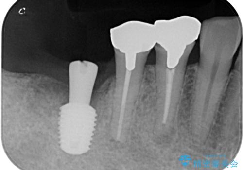 他院で抜歯をしたのでインプラントを入れたい インプラント治療の治療中