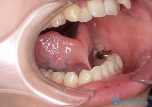 舌の動きを改善する舌小帯形成術の症例 治療前