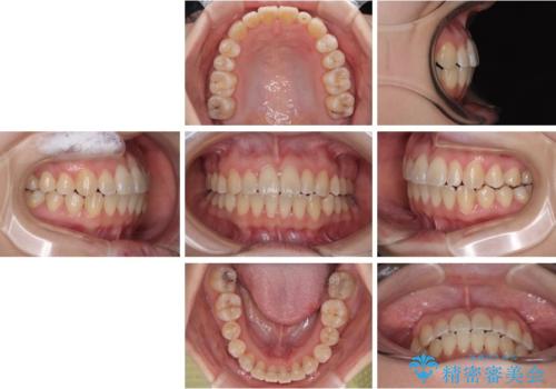 早く・確実に歯並び改善|目立ちにくいワイヤー矯正の治療後