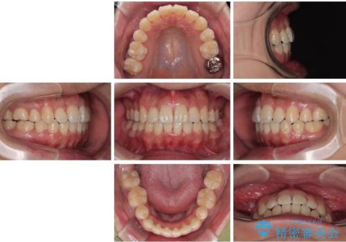 前歯のデコボコを抜歯矯正で改善した症例|目立ちにくい審美装置を使用の治療後