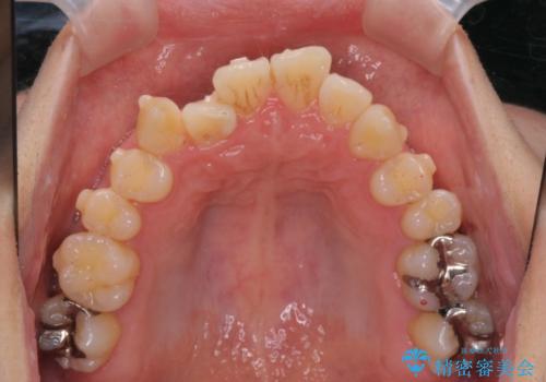 ねじれ・がたつきのある前歯を改善の治療前