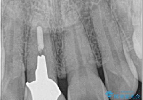 前歯の色が気になる。の治療前