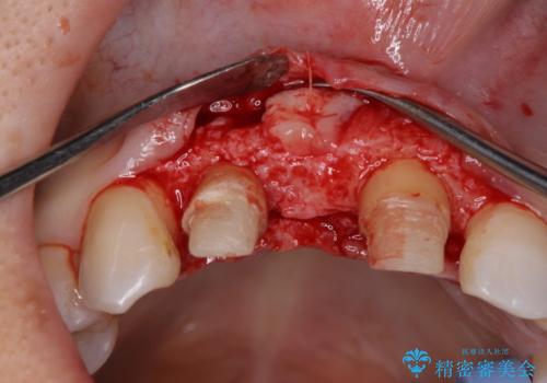 外れやすい前歯のブリッジ しっかりとした治療を受けたいの治療中