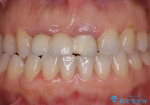 外れやすい前歯のブリッジ しっかりとした治療を受けたいの治療前